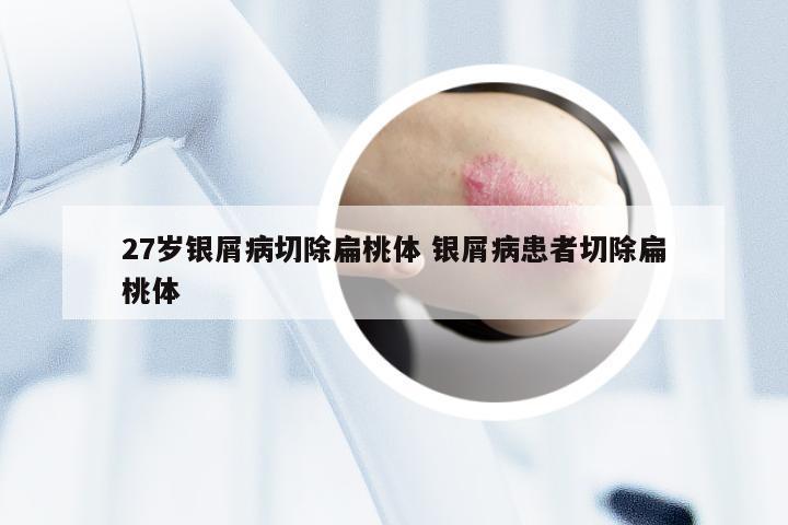 27岁银屑病切除扁桃体 银屑病患者切除扁桃体