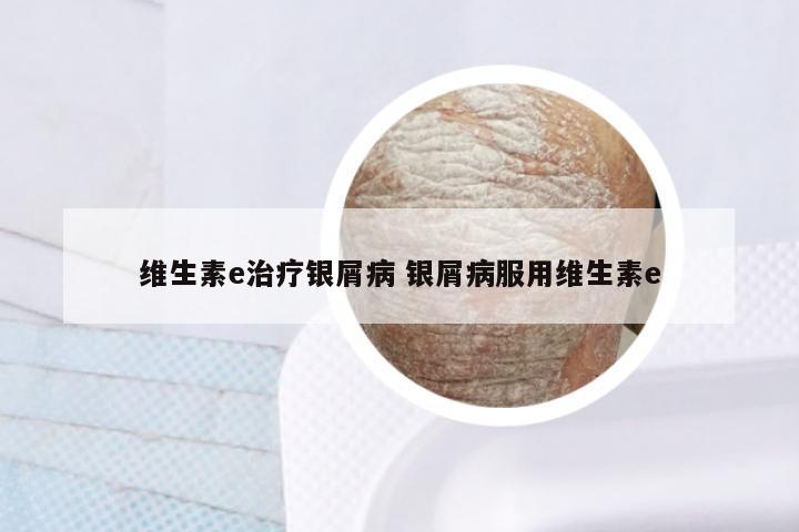 维生素e治疗银屑病 银屑病服用维生素e