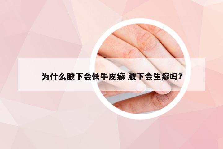 为什么腋下会长牛皮癣 腋下会生癣吗?