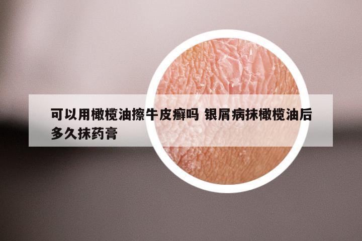 可以用橄榄油擦牛皮癣吗 银屑病抹橄榄油后多久抹药膏