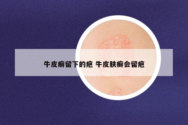 牛皮癣留下的疤 牛皮肤癣会留疤