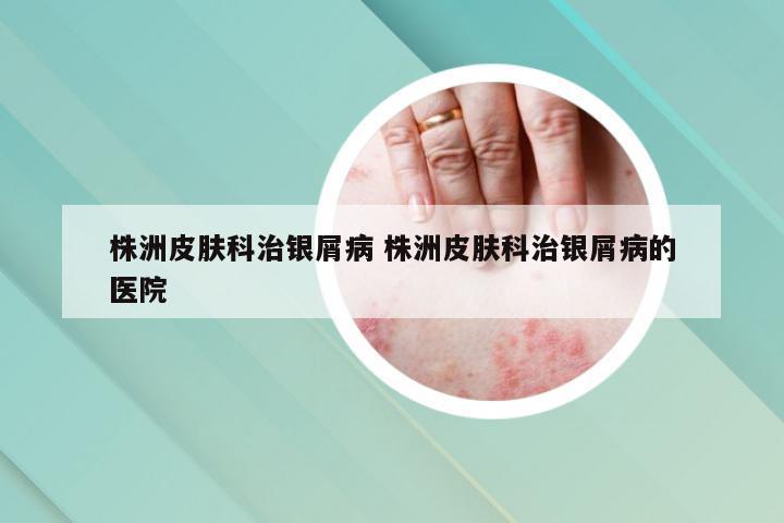 株洲皮肤科治银屑病 株洲皮肤科治银屑病的医院