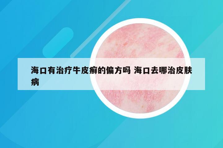 海口有治疗牛皮癣的偏方吗 海口去哪治皮肤病