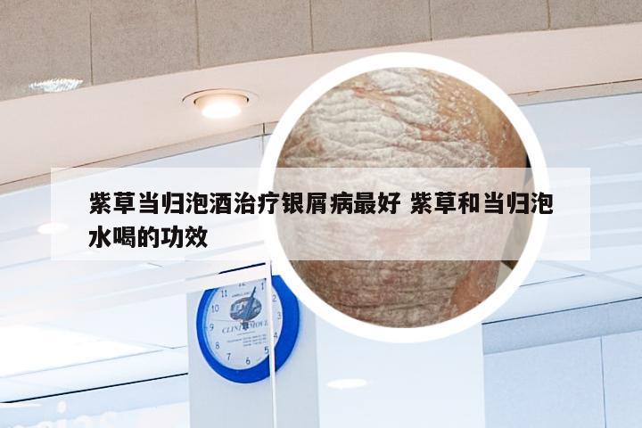 紫草当归泡酒治疗银屑病最好 紫草和当归泡水喝的功效