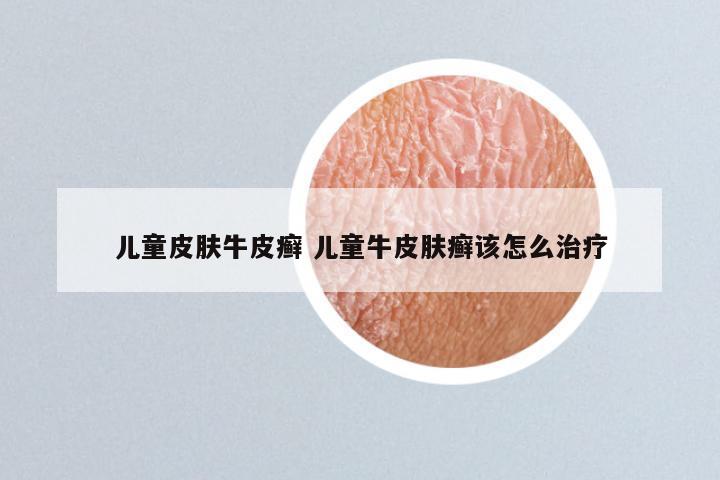 儿童皮肤牛皮癣 儿童牛皮肤癣该怎么治疗