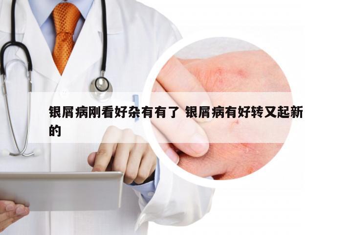 银屑病刚看好杂有有了 银屑病有好转又起新的