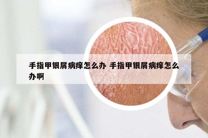 手指甲银屑病痒怎么办 手指甲银屑病痒怎么办啊