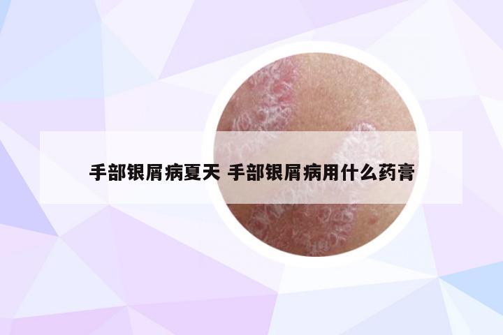 手部银屑病夏天 手部银屑病用什么药膏
