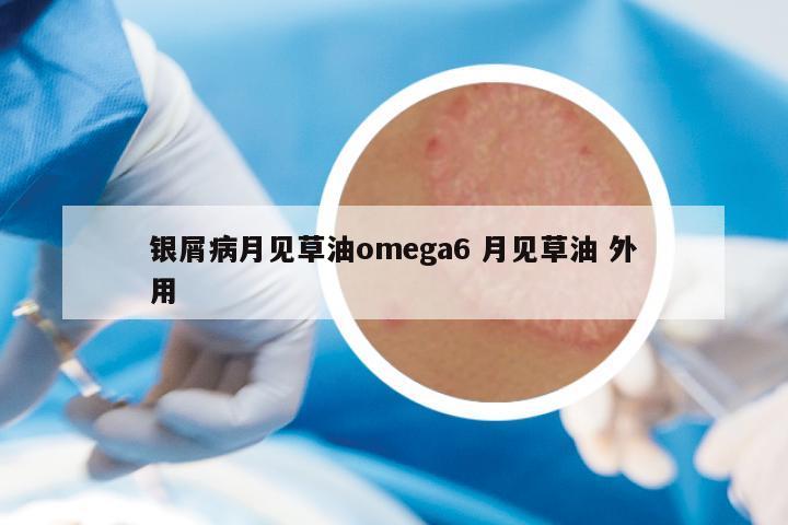 银屑病月见草油omega6 月见草油 外用