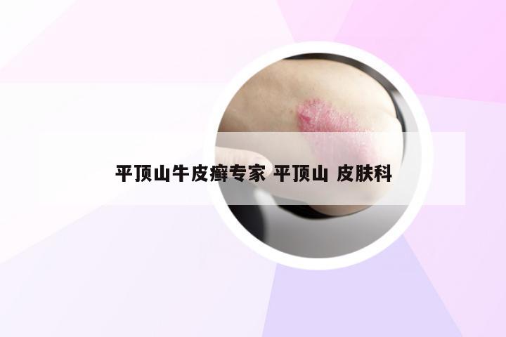 平顶山牛皮癣专家 平顶山 皮肤科
