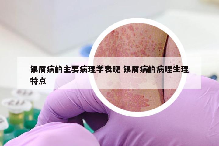 银屑病的主要病理学表现 银屑病的病理生理特点