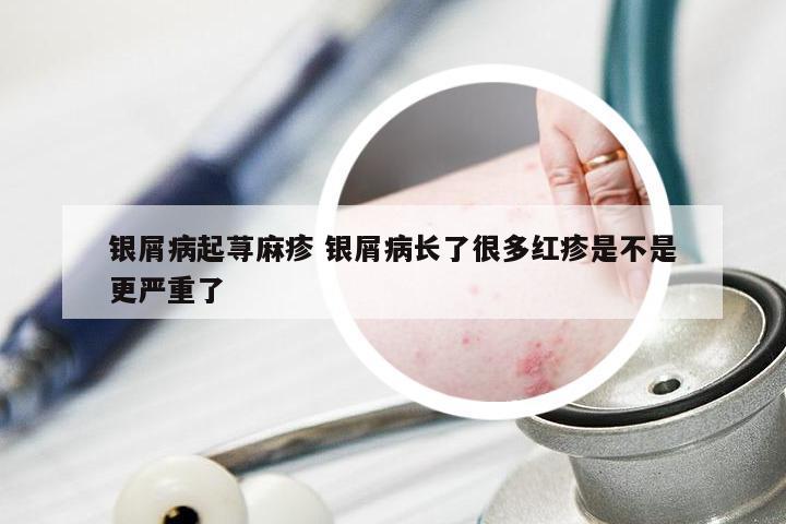 银屑病起荨麻疹 银屑病长了很多红疹是不是更严重了