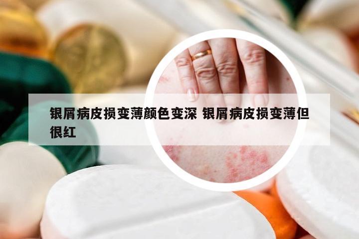 银屑病皮损变薄颜色变深 银屑病皮损变薄但很红