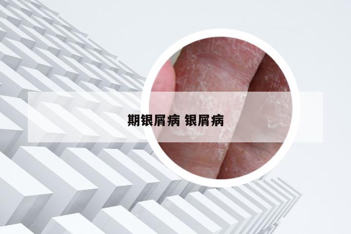 期银屑病 银屑病
