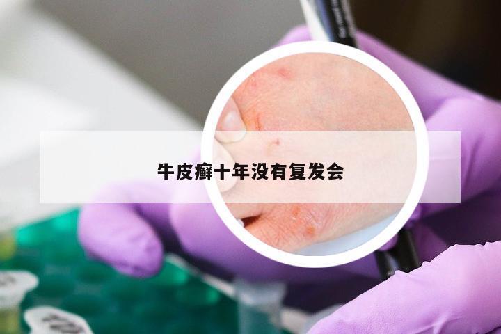 牛皮癣十年没有复发会
