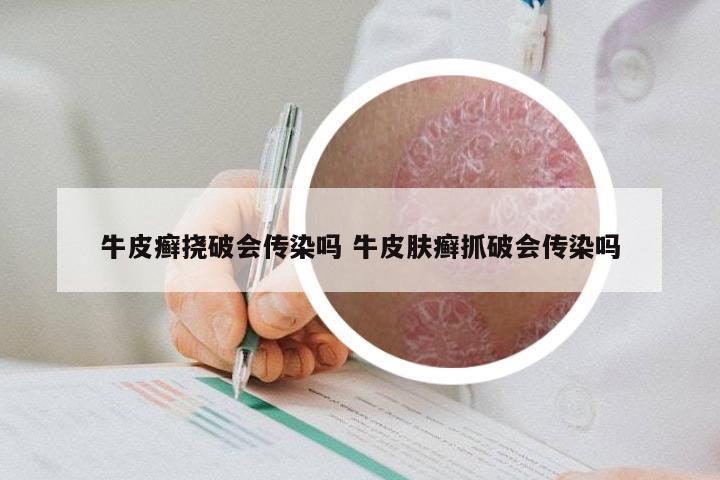 牛皮癣挠破会传染吗 牛皮肤癣抓破会传染吗