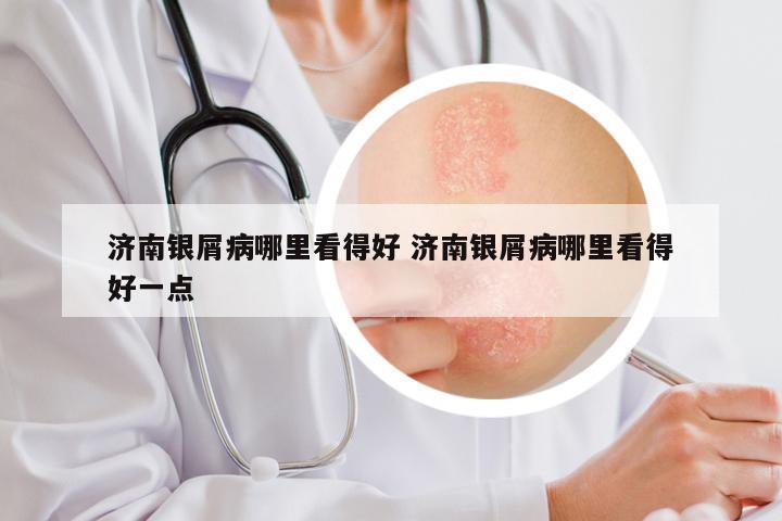 济南银屑病哪里看得好 济南银屑病哪里看得好一点