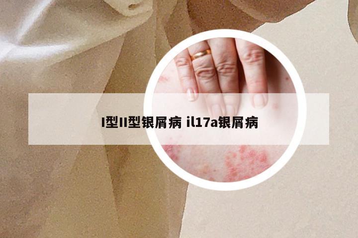 I型II型银屑病 il17a银屑病