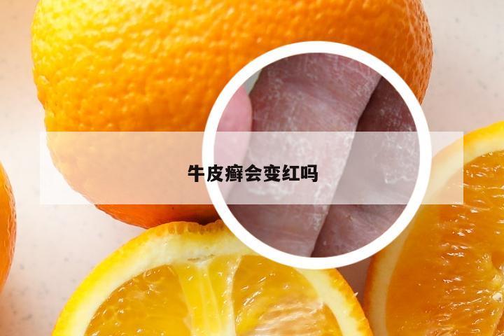 牛皮癣会变红吗
