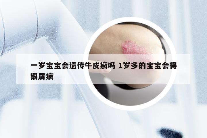 一岁宝宝会遗传牛皮癣吗 1岁多的宝宝会得银屑病