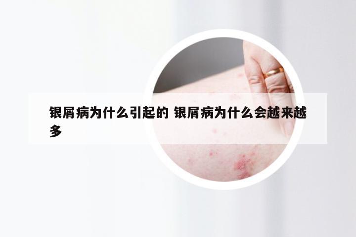 银屑病为什么引起的 银屑病为什么会越来越多