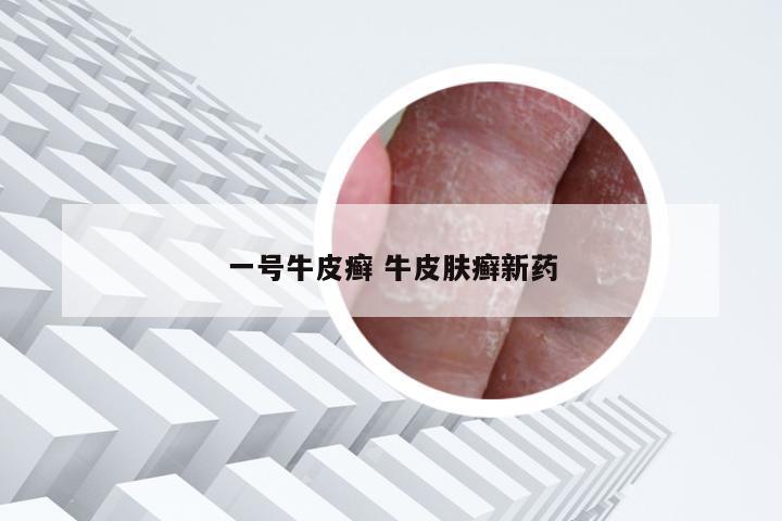 一号牛皮癣 牛皮肤癣新药