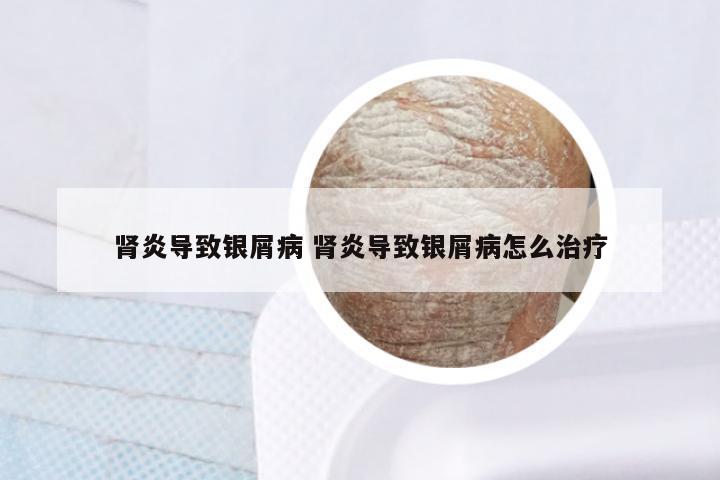 肾炎导致银屑病 肾炎导致银屑病怎么治疗