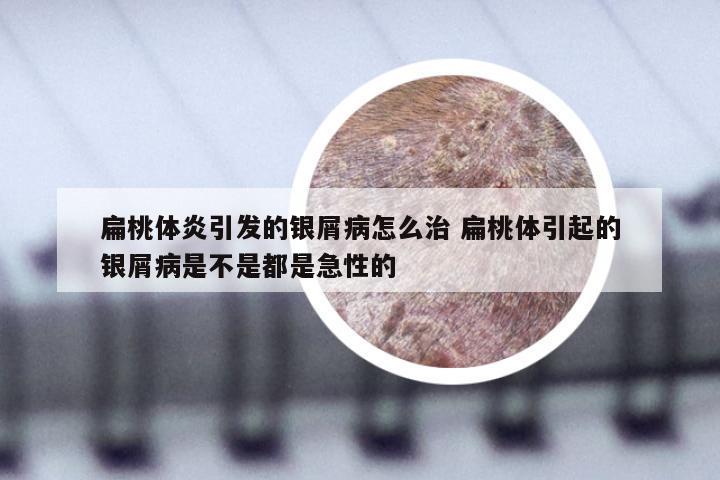 扁桃体炎引发的银屑病怎么治 扁桃体引起的银屑病是不是都是急性的