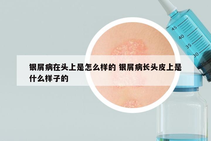 银屑病在头上是怎么样的 银屑病长头皮上是什么样子的