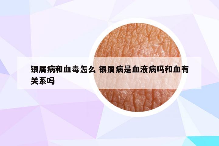 银屑病和血毒怎么 银屑病是血液病吗和血有关系吗