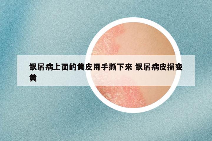 银屑病上面的黄皮用手撕下来 银屑病皮损变黄