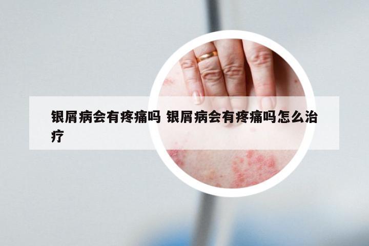 银屑病会有疼痛吗 银屑病会有疼痛吗怎么治疗