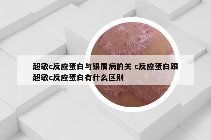 超敏c反应蛋白与银屑病的关 c反应蛋白跟超敏c反应蛋白有什么区别