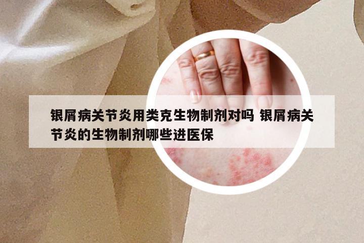 银屑病关节炎用类克生物制剂对吗 银屑病关节炎的生物制剂哪些进医保