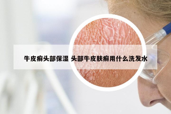 牛皮癣头部保湿 头部牛皮肤癣用什么洗发水