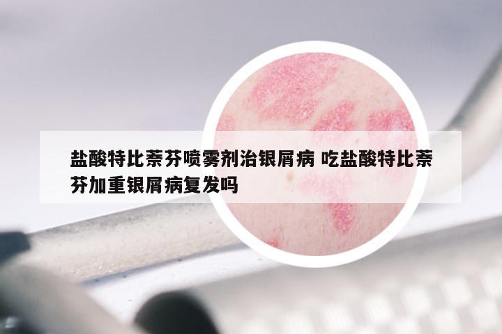 盐酸特比萘芬喷雾剂治银屑病 吃盐酸特比萘芬加重银屑病复发吗