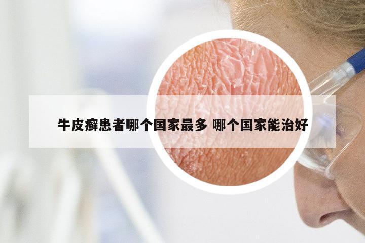 牛皮癣患者哪个国家最多 哪个国家能治好
