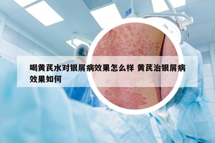 喝黄芪水对银屑病效果怎么样 黄芪治银屑病效果如何