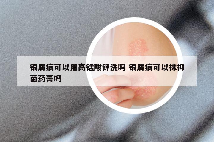 银屑病可以用高锰酸钾洗吗 银屑病可以抹抑菌药膏吗