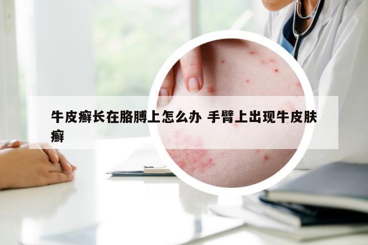牛皮癣长在胳膊上怎么办 手臂上出现牛皮肤癣