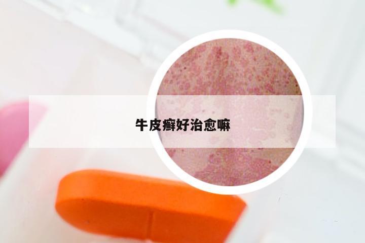 牛皮癣好治愈嘛