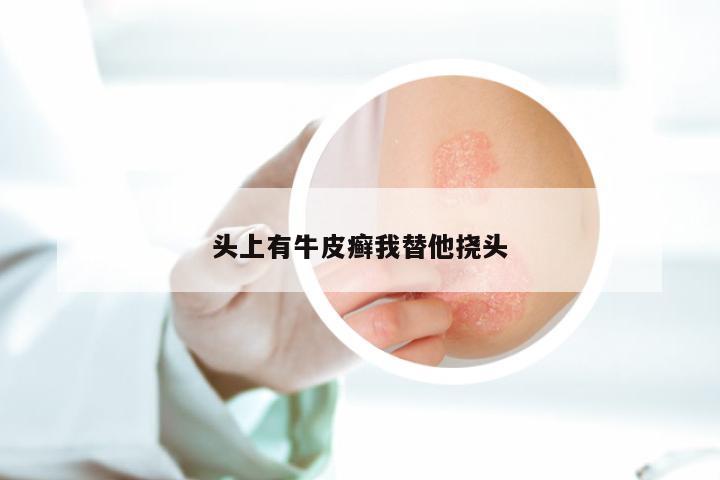 头上有牛皮癣我替他挠头