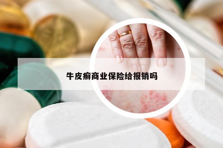 牛皮癣商业保险给报销吗