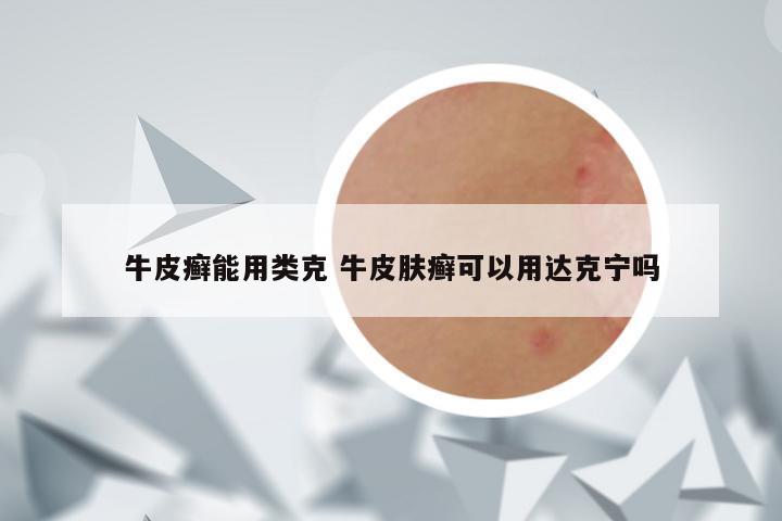 牛皮癣能用类克 牛皮肤癣可以用达克宁吗