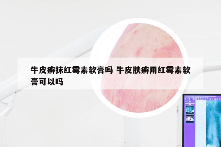 牛皮癣抹红霉素软膏吗 牛皮肤癣用红霉素软膏可以吗