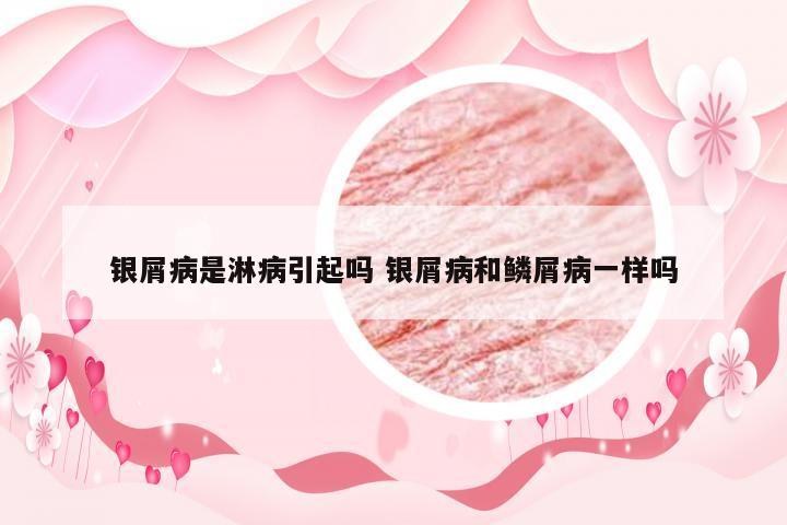 银屑病是淋病引起吗 银屑病和鳞屑病一样吗
