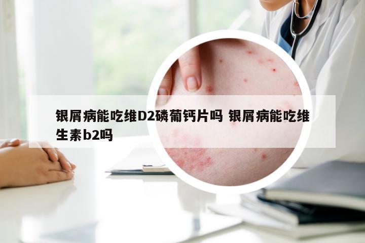 银屑病能吃维D2磷葡钙片吗 银屑病能吃维生素b2吗