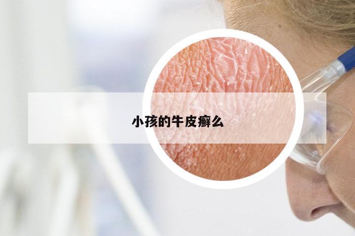 小孩的牛皮癣么
