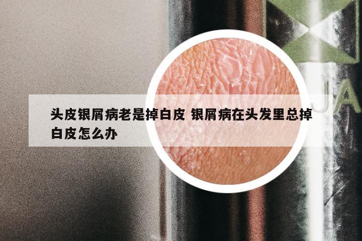 头皮银屑病老是掉白皮 银屑病在头发里总掉白皮怎么办