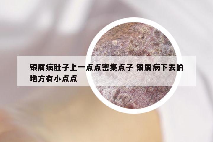 银屑病肚子上一点点密集点子 银屑病下去的地方有小点点